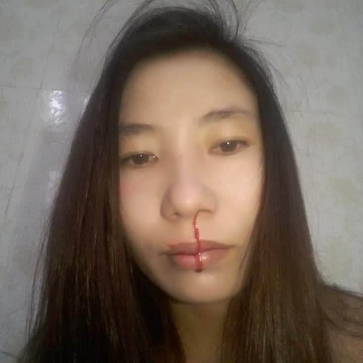 Thu Le_bloody nose after attack